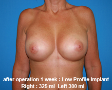 plastic-surgery-breast-augmentation